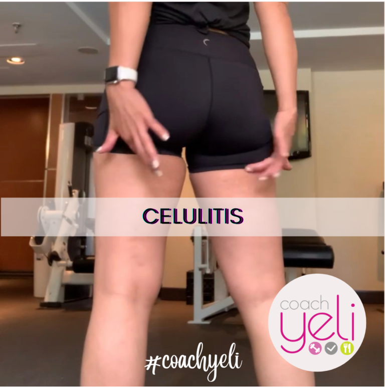 celulitis